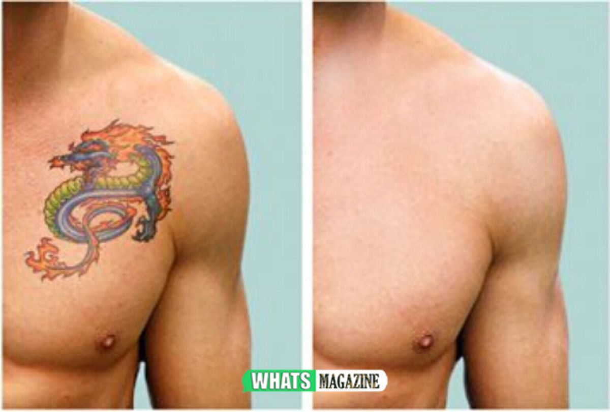 How Much Does Tattoo Removal Cost? Whatsmagazine