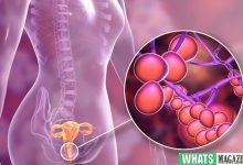 Yeast Infection