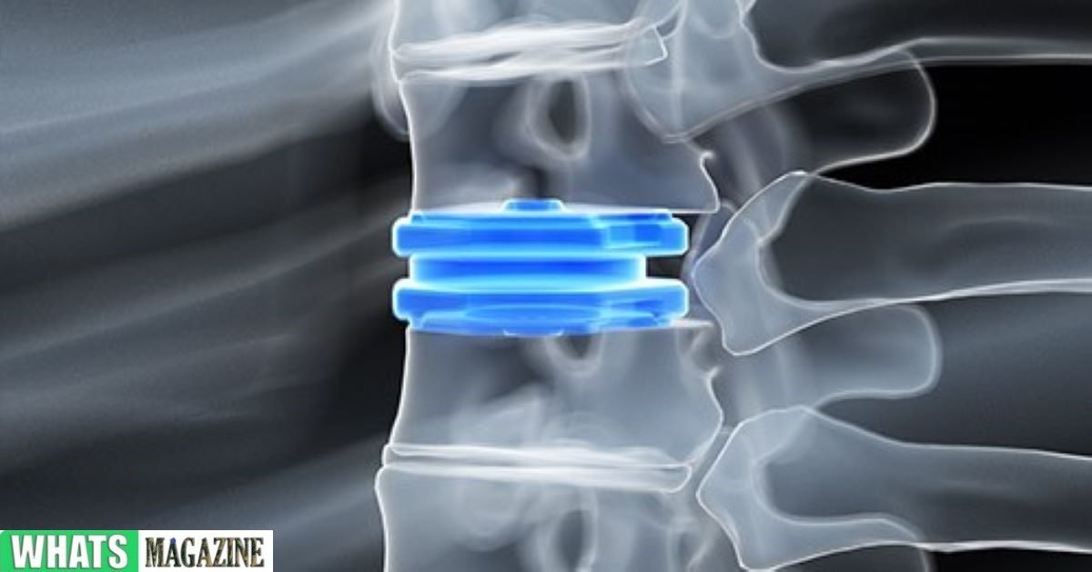 Spinal Fusion