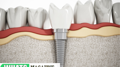 Dental Implant