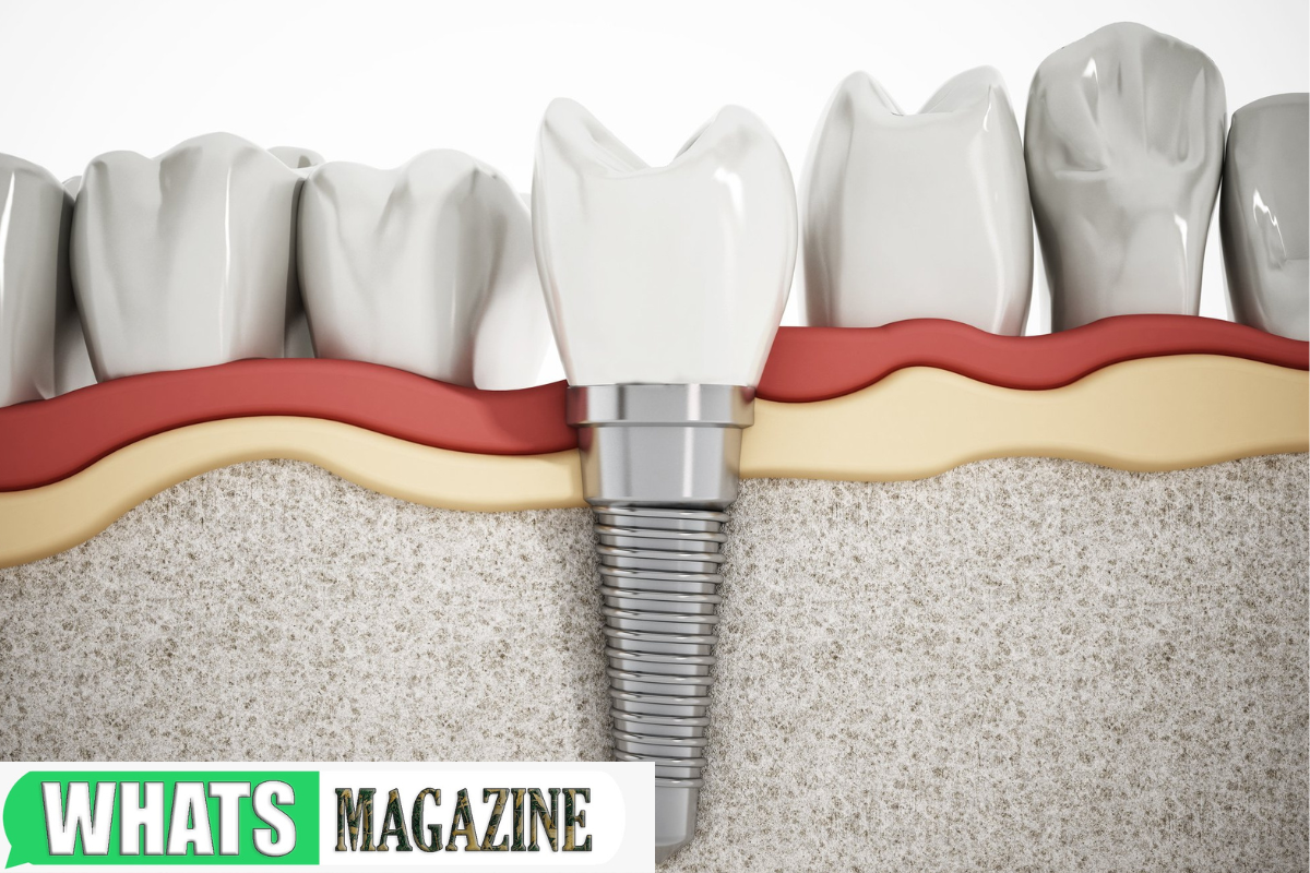 Dental Implant