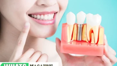 Dental Implant Recovery A Guide for Patients