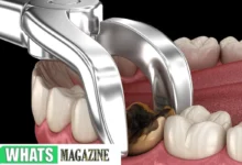 Emergency Dental Extraction