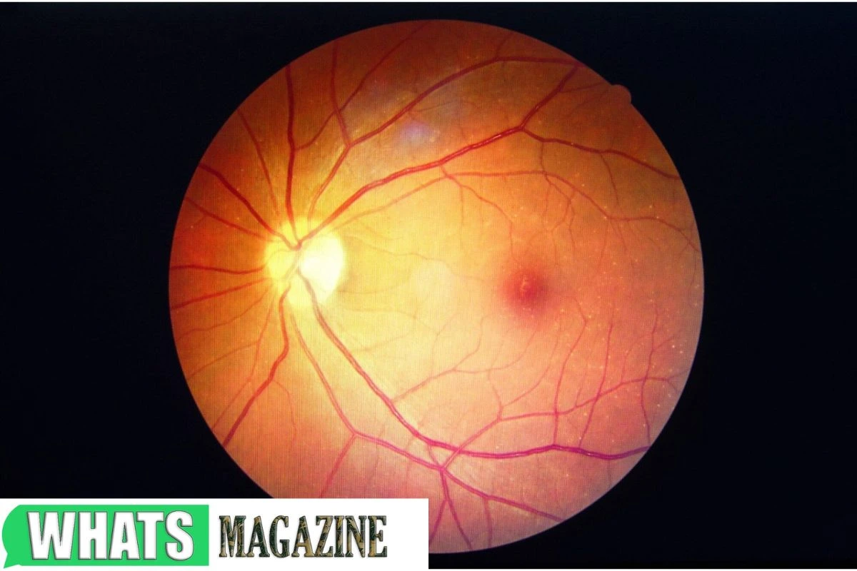 Healthy Retina vs. an Unhealthy Retina Signs You Might Have a Retinal Disease