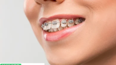 The Surprising Benefits of Metal Teeth Braces Beyond Straightening Teeth