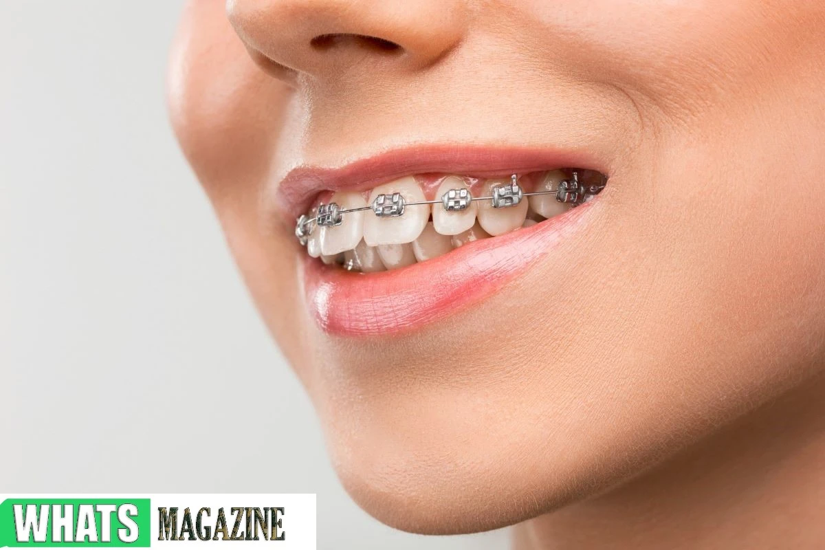The Surprising Benefits of Metal Teeth Braces Beyond Straightening Teeth