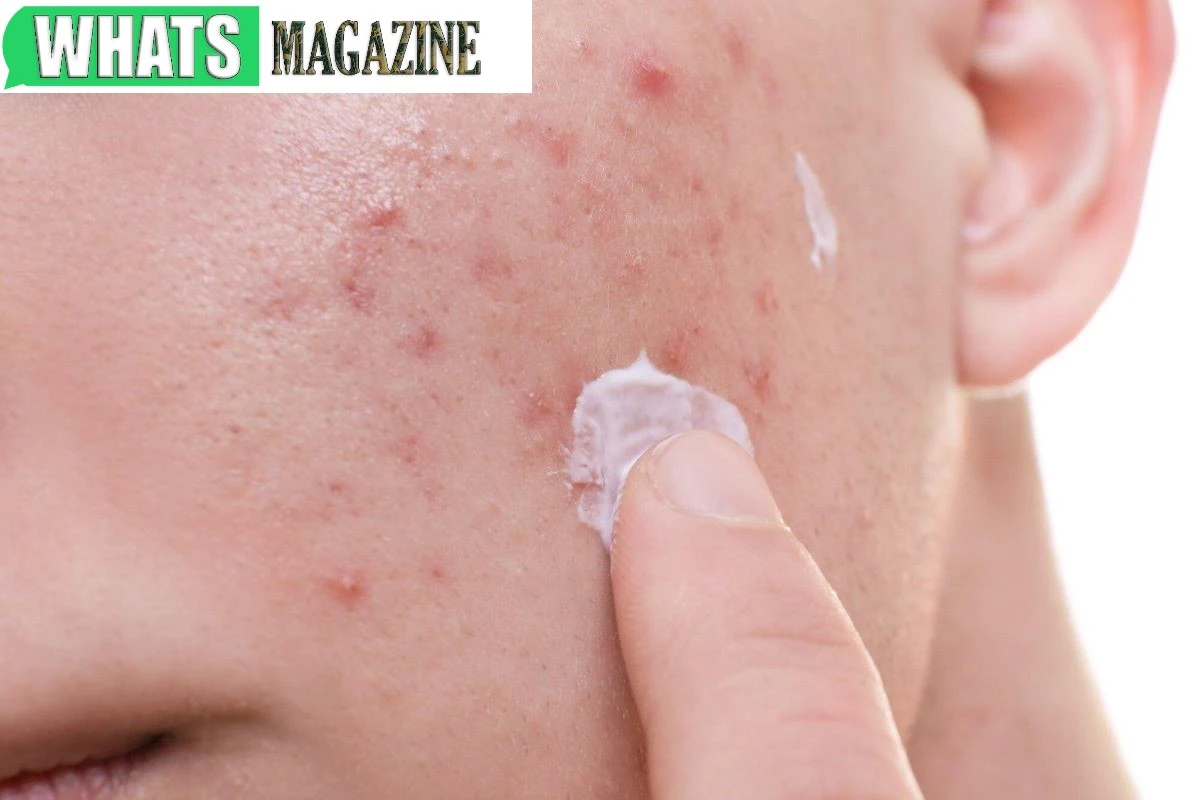 Tips for Choosing the Right Acne Facial Treatment for Your Skin Type